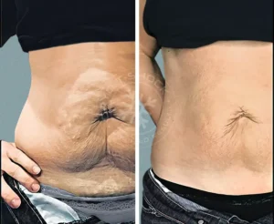 A woman with a hairy belly and stomach in two different pictures.