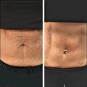 A before and after photo of the stomach area.