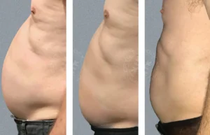 A man 's stomach before and after his weight loss.