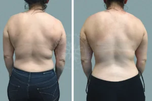 A woman with a back injury and a rear view of the same person.