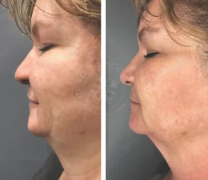 A woman with a facelift and chin implant