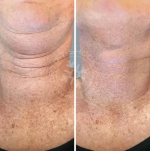 A before and after picture of the neck area.