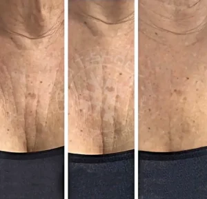 A woman 's chest and stomach showing before, during and after the procedure.